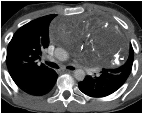 Mediastinal Germ Cell Tumor