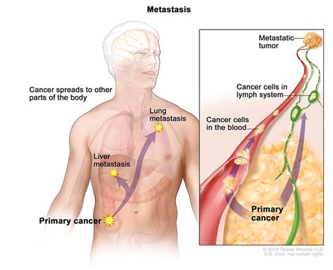 Metastatic Cancer National Cancer Institute