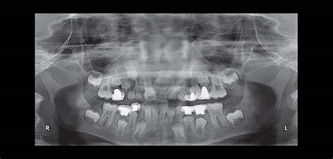 052 Pulpectomía En Hiperemia Pulpa Y Aceleración De La Reabsorción