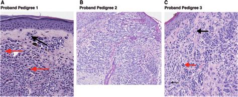 Histology Of Tumors From Bap1 Probands A Histopathological Findings