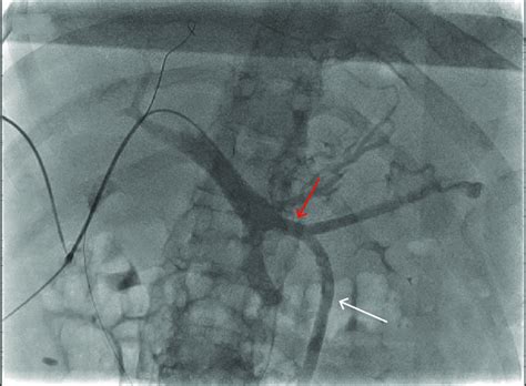 Ultrasound Showing Percutaneous Transhepatic Access Of The Right Portal