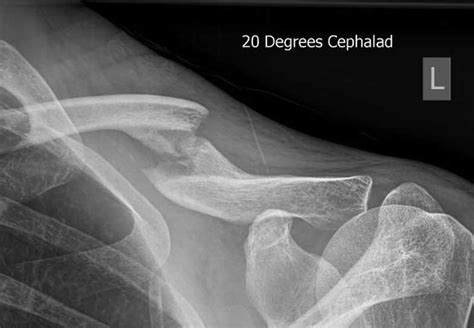 Mal United Clavicle Non Union Fracture Dr David Duckworth