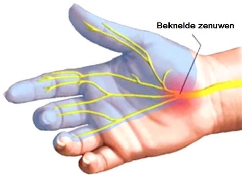 Carpaal Tunnel Syndroom Informatie Debraceshop Nl