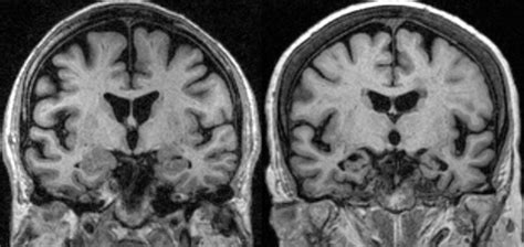 Corticobasal Degeneration - Symptoms & Causes