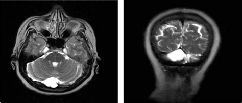 Figure 2 From Polymorphic Clinical Presentation Of Cerebellar Arachnoid