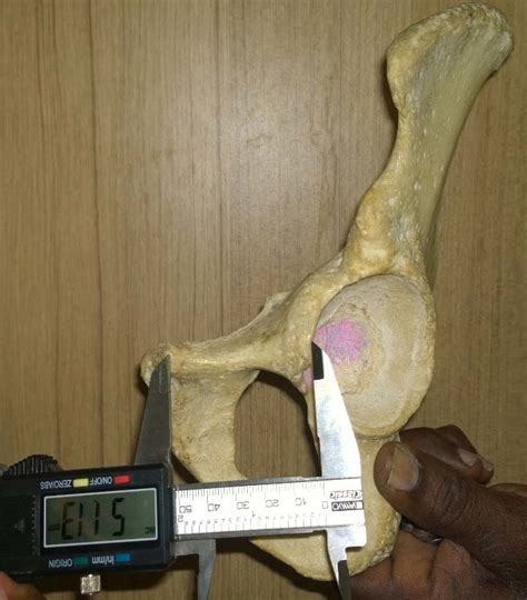 Sex Determination By Biometry Of Anterior Features Of Human Hip Bones In South Indian Population