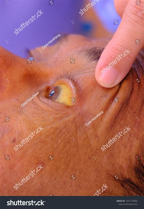 Severe Jaundice Icterus Demonstrated On Sclera Stock Fotografie