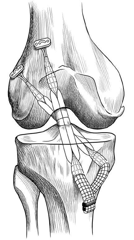 Ulnar Collateral Ligament Reconstruction Procedure