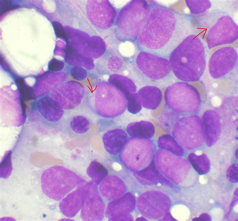 Landmark Study Shows Acute Myeloid Leukaemia Is At Least 11 Different