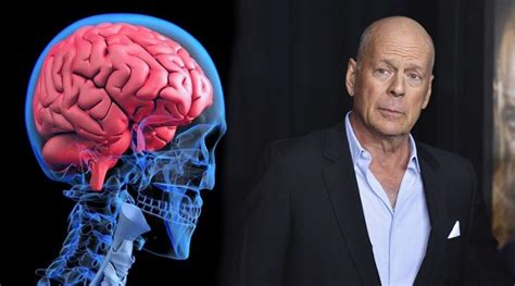 Afasia Qu Es La Enfermedad Que Oblig A Bruce Willis A Dejar La