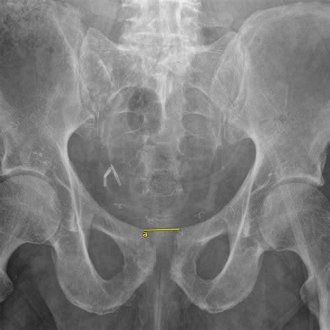 Inlet Radiograph Of The Pelvis With The Yellow Lines Demonstrating The