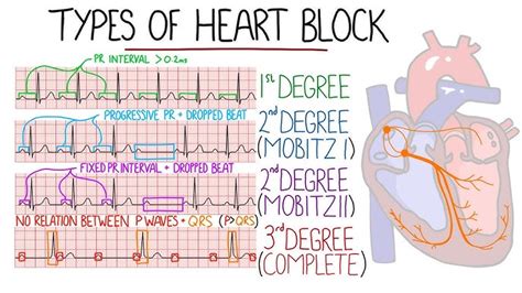 AV Heart Block Poem: First, Second, Third Degree Types, ECG, 59% OFF