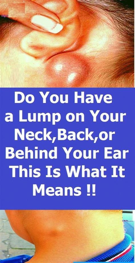 Vital Pieces Of Lumps On Neck Healthy Medicine Tips Skin Bumps