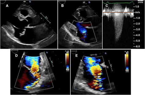 Patient With Primary MR With Typical Features Of Barlow S Disease