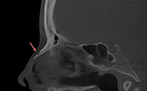 What is the Best Imaging Study to Evaluate a Broken Nose?