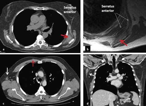 1 Thoracic Wall Thoracic Key