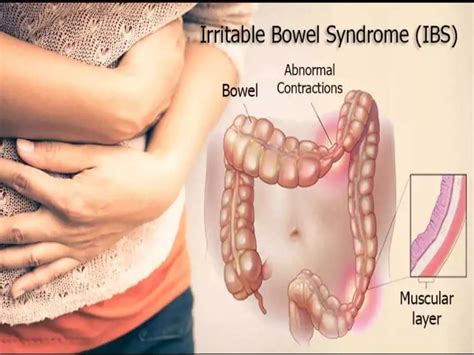 Irritable Bowel Syndrome Ppt