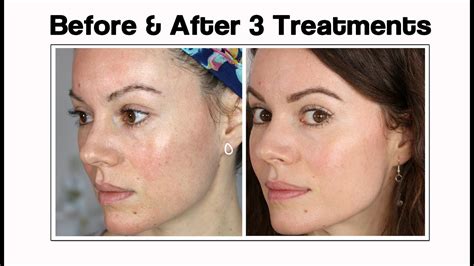 Microneedling Before And After Pro Needling 47 Off