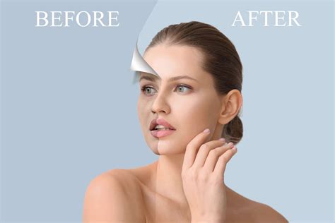 Forma Skin Tightening Before And After Witness The Results