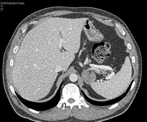 Myelolipoma Left Adrenal Gland Rradiology