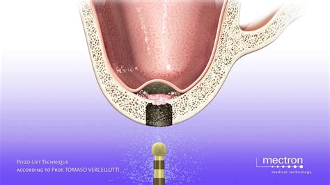 Piezosurgery Animation Sinus Lift With Crestal Approach Piezo