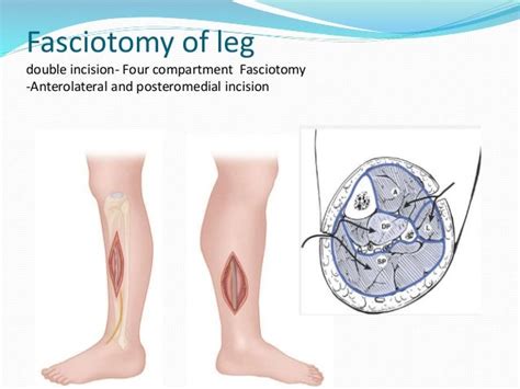 Compartment syndrome