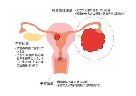 婦人科がん 一般社団法人 日本がん・生殖医療学会