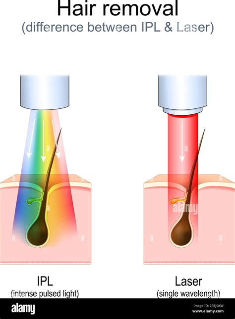 Laser Vs Pulsed Light Hair Removal Shop