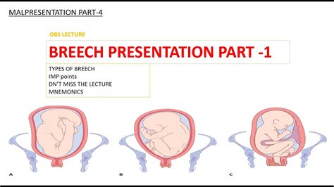 Breech Presentation Part 1 Malpresentation Part4 Gynae Obs Lecture