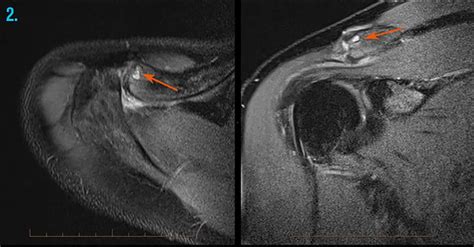 Mri And X Ray For Shoulder Injury Melbourne