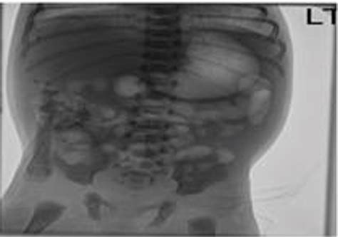 Figure 1 From A Case Of In Utero Meconium Peritonitis In A Fetus