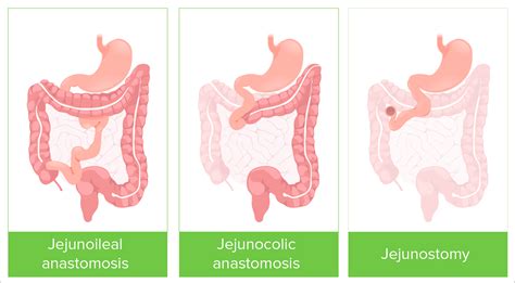 Short Bowel Syndrome | Concise Medical Knowledge