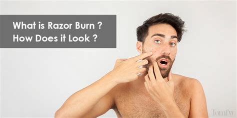 Quick Ways To Get Rid Of Razor Burn