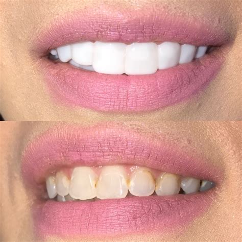 Shiny Smile Veneers Review Before And After Photos