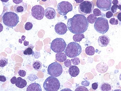 Acute Erythroid And Megakaryocytic Leukemia Bcl Xl Dependence Its