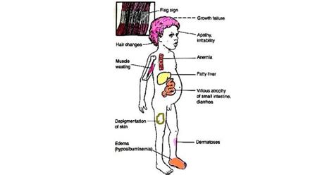 Kwashiorkor - New