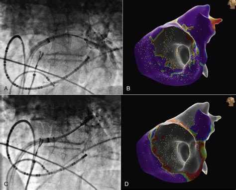 Pulmonary Vein Isolation By Cryoballoon Catheter Thoracic Key