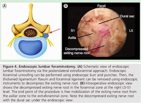 Decompression: Lateral Recess Decompression