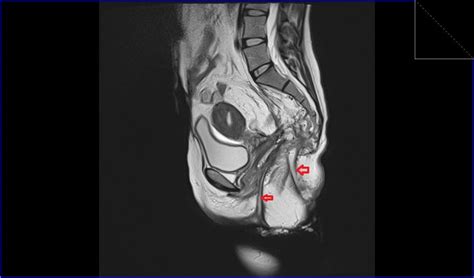 Anorectal Fistula Mri Perianal Fistula Radiology