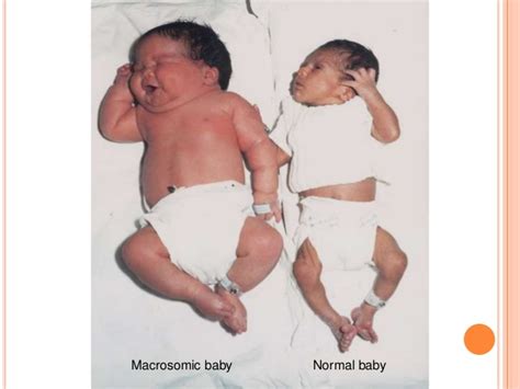 Gestational Diabetes