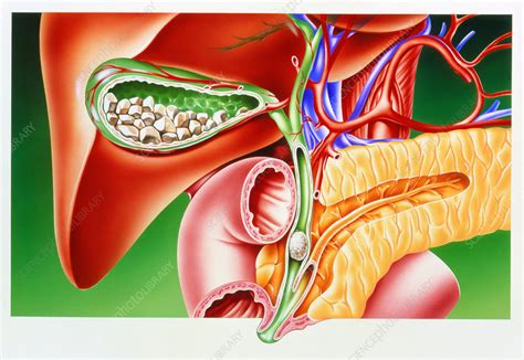 Gallstones In Gall Bladder And Bile Duct Stock Image M1650141