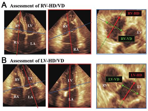 Assessment Of Right Ventricular Rv Hdvd And Left Ventricular