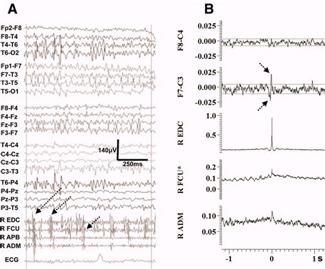 Electrophysiological Findings From Case 6 A Eeg Emg Polygraphy Showing Download Scientific