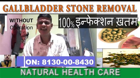 Gallbladder Stone Treatment Without Operation