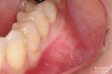 Focal Cemento Osseous Dysplasia Histology