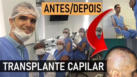 TRANSPLANTE CAPILAR NO BRASIL ANTES E DEPOIS DO TRASNPLANTE CAPILAR