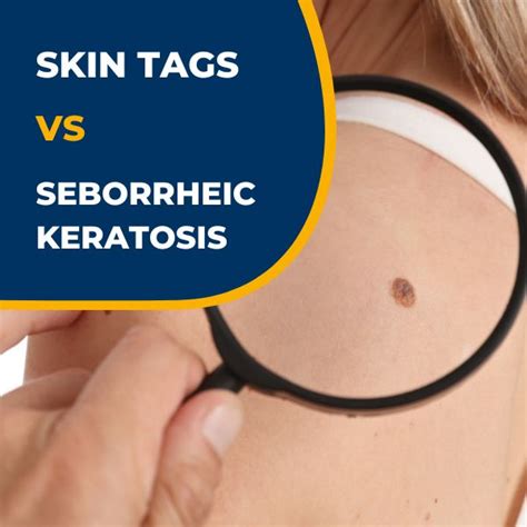 Seborrheic Keratosis Archives Dundrum Cosmetic Clinic