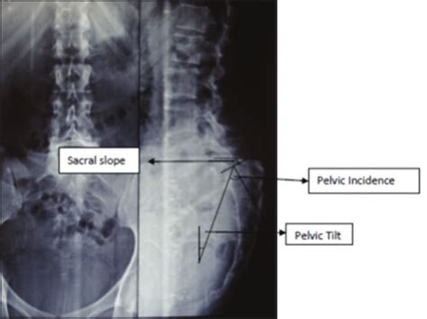 High Grade Spondylolisthesis Showing Sacral Slope Pelvic Tilt And Pi