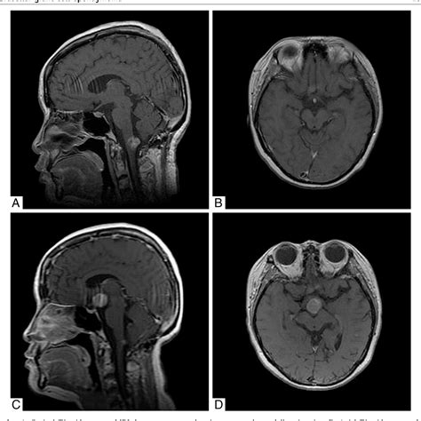 Figure From Suprasellar Giant Cell Ependymoma A Rare Neoplasm In A