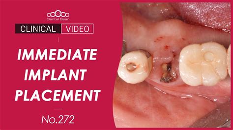 Immediate Implant Placement After Extraction Dr Jeon Inseong